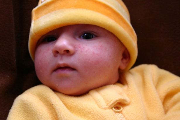 Hoe de baby acne te behandelen. Behandel babyacne geheel verschillend van adolescent of volwassen acne.